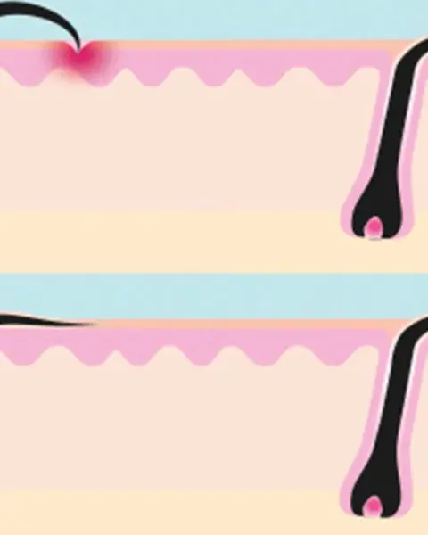 نصائح مذهلة للتخلص من نمو الشعر تحت الجلد