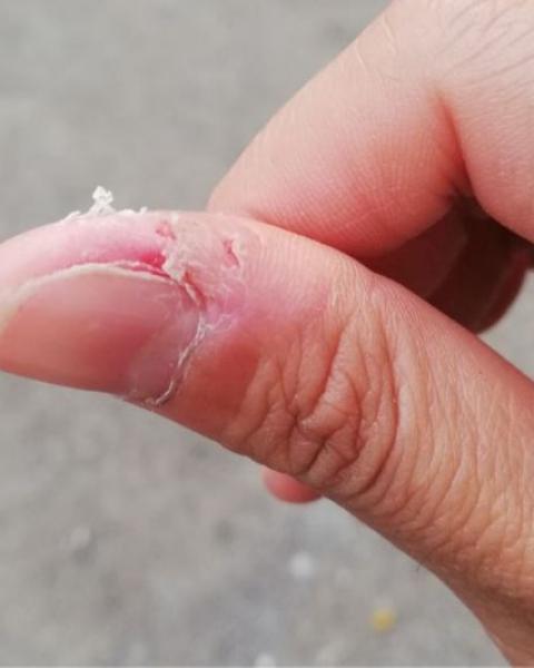 عالجي تشقق الجلد حول الأظافر بهذه الطريقة