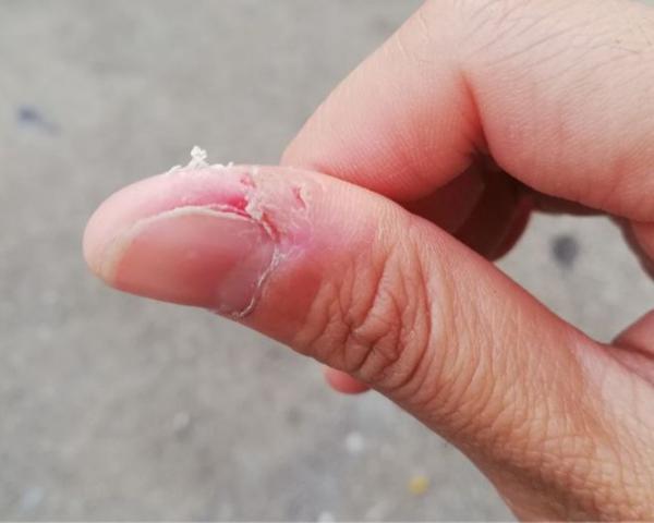 عالجي تشقق الجلد حول الأظافر بهذه الطريقة